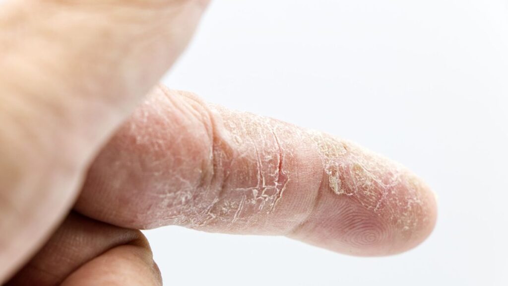 Gros plan sur des mains sèches et râpeuses